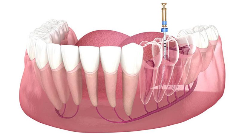 تشخیص عفونت دندان عصب کشی شده