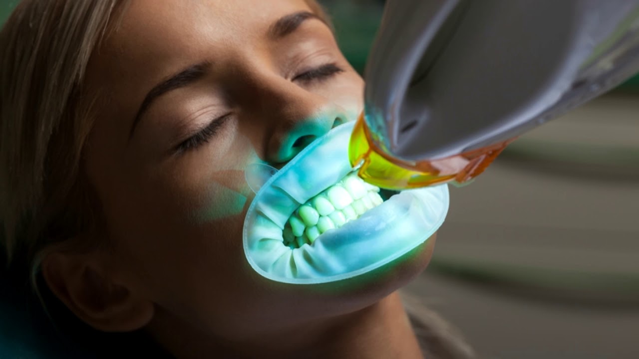 ماندگاری بلیچینگ دندان