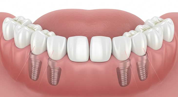 ایمپلنت All On 4