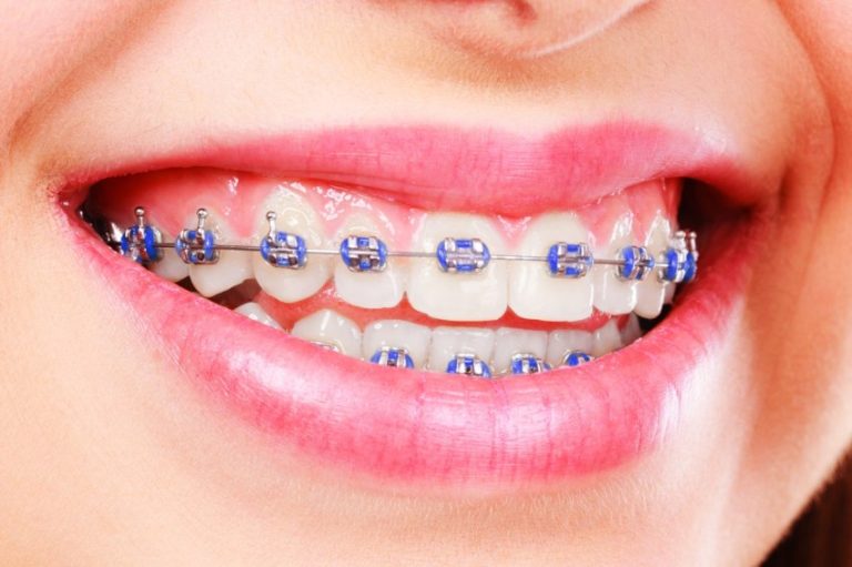 ارتودنسی بزرگسالان