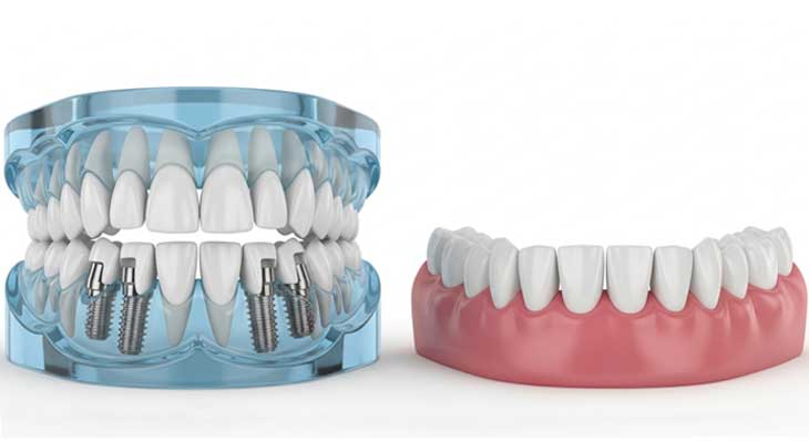 ایمپلنت All On 4
