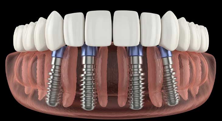 ایمپلنت All On 4