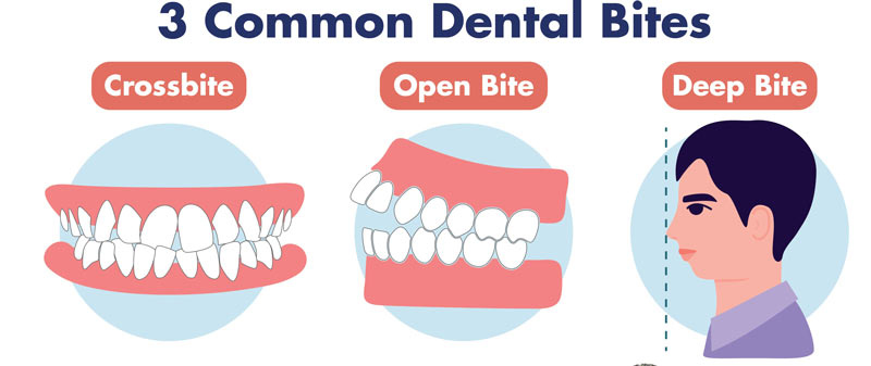 انواع مال اکولوژن