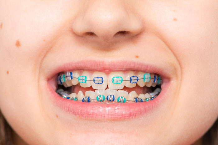 سن مناسب ارتودنسی