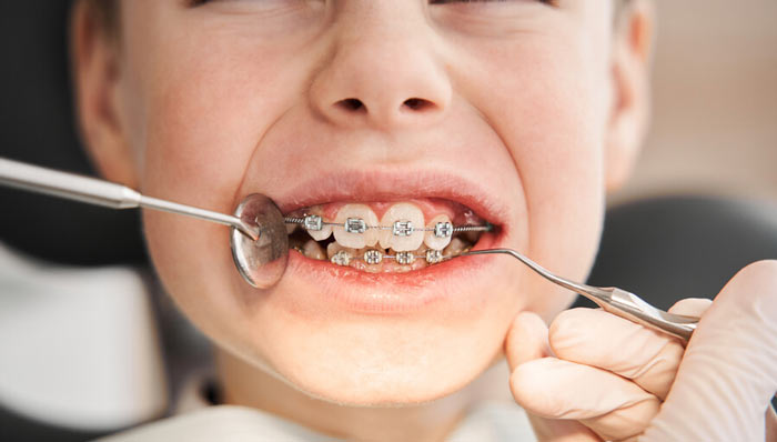 سن و زمان مناسب ارتودنسی