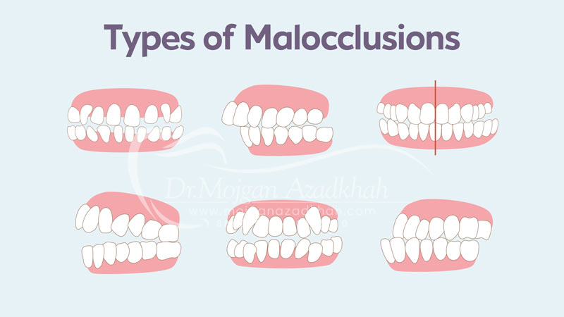 درمان مال اکولوژن
