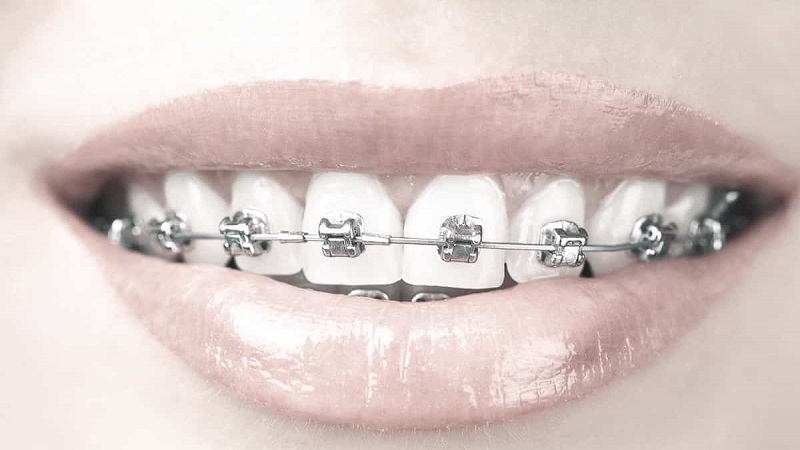 سن مناسب ارتودنسی