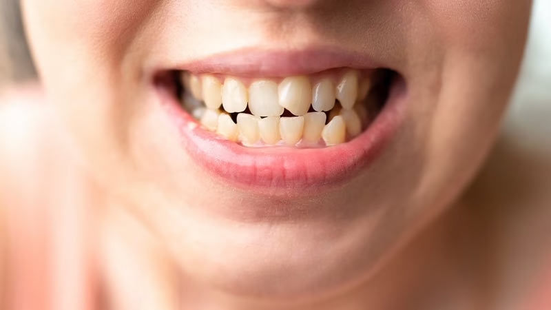 درمان شلوغی دندان تهران