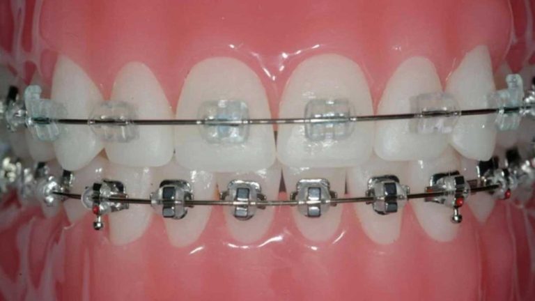ارتودنسی سرامیکی بهتر است یا فلزی