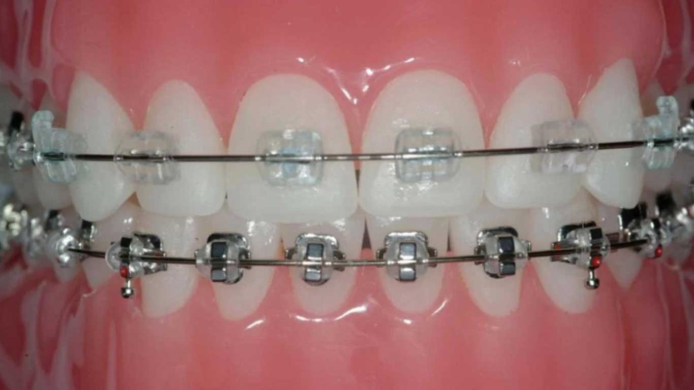 ارتودنسی سرامیکی بهتر است یا فلزی