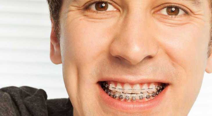 ارتودنسی در 40 سالگی و بالاتر