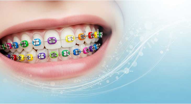 ارتودنسی رنگی