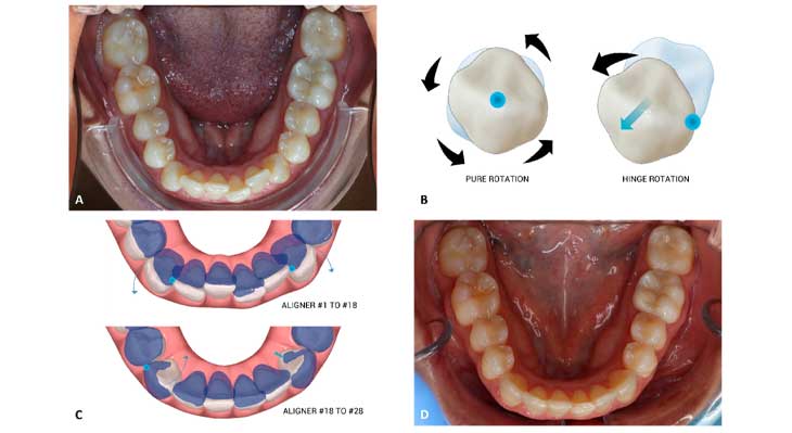جابجایی و چرخش دندان