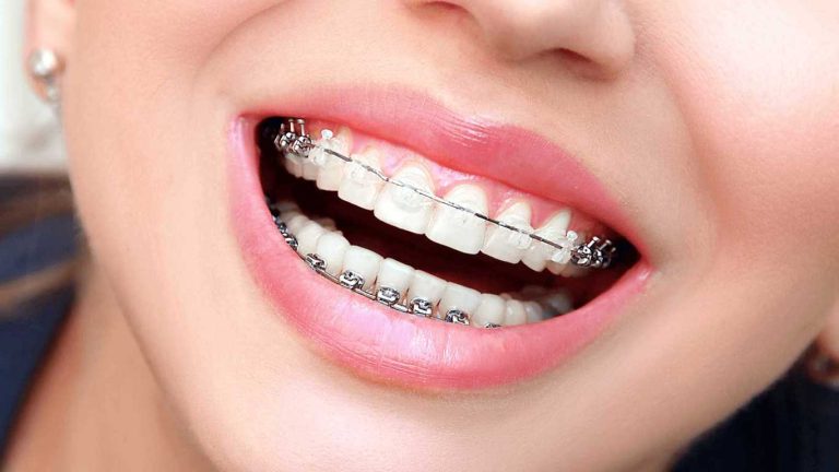 ارتودنسی سرامیکی