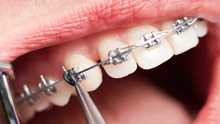 براکت ارتودنسی