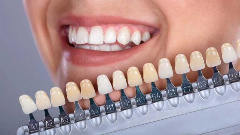 رنگ روکش دندان