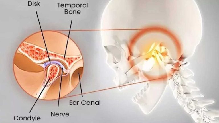 اختلال مفصل گیجگاهی فکی