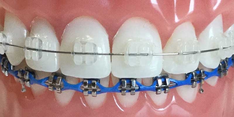ارتودنسی سرامیکی بهتر است یا فلزی