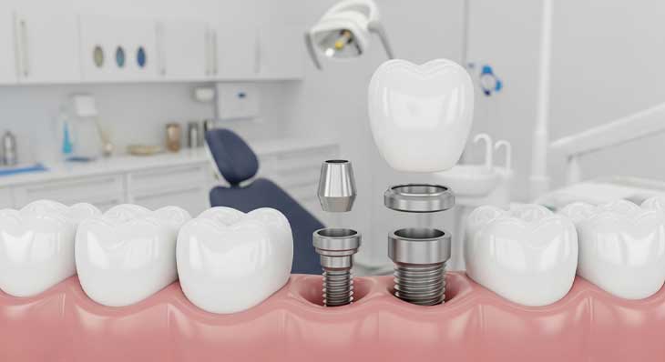 کاشت مجدد ایمپلنت