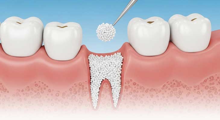 بازسازی استخوان فک