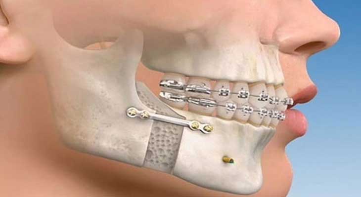 ارتودنسی فک پایین