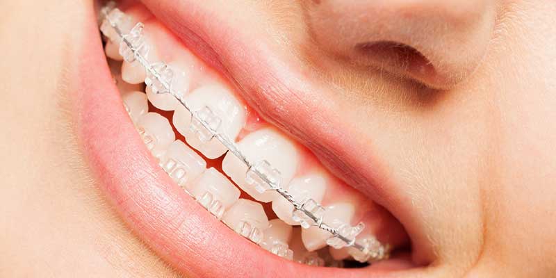 ارتودنسی سرامیکی