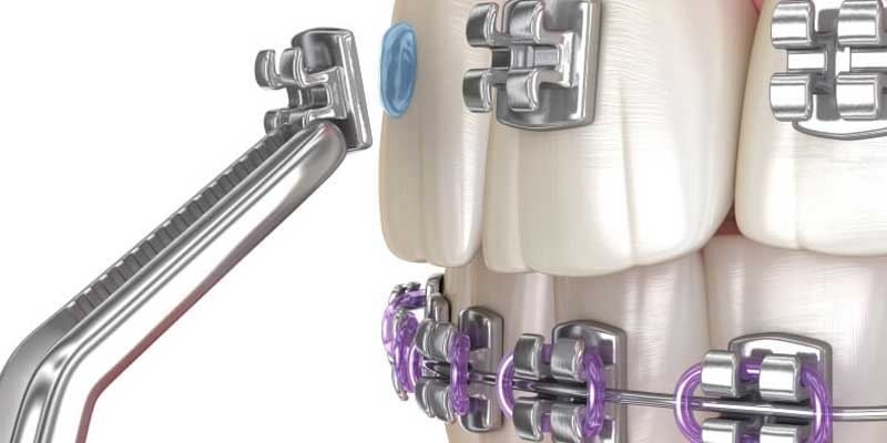 براکت ارتودنسی