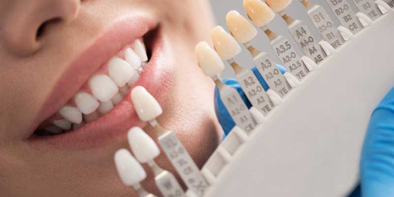 رنگ روکش دندان