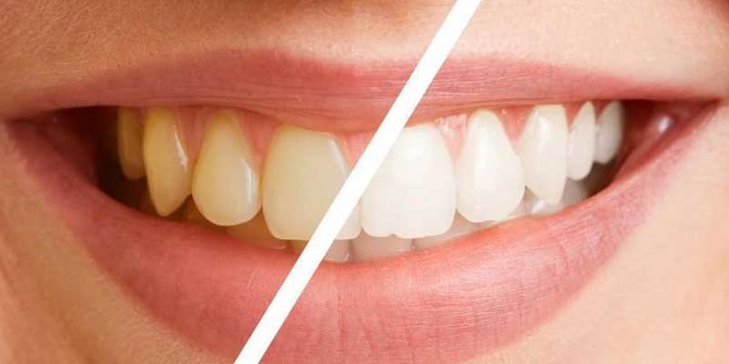 ترمیم دندان