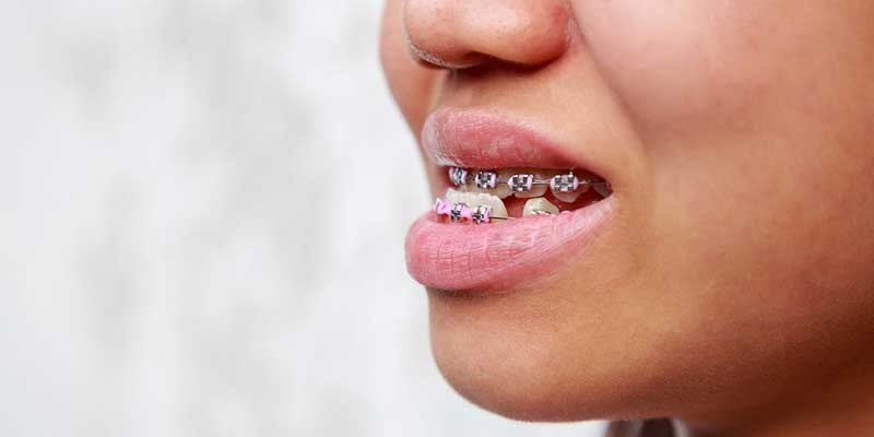 جلو بودن فک پایین