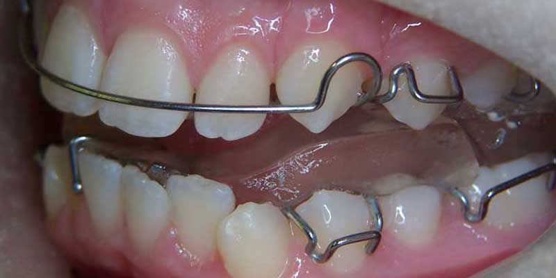 ارتودنسی فانکشنال