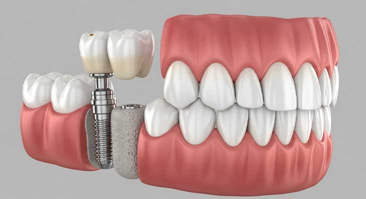 بازسازی استخوان فک