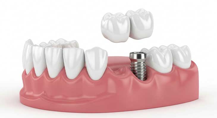 ایمپلنت دو دندان کنار هم