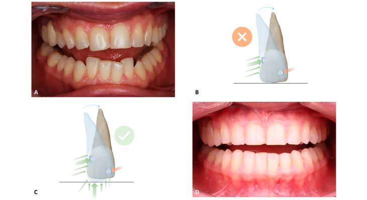 جابجایی و چرخش دندان