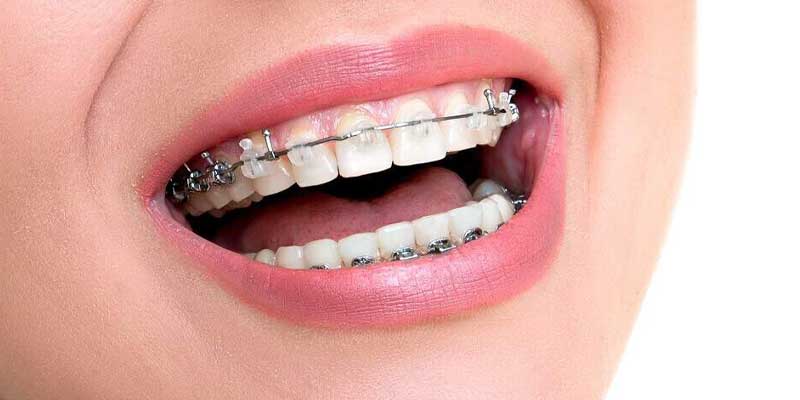 ارتودنسی سرامیکی