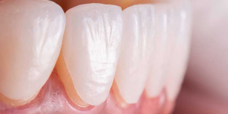 رنگ روکش دندان