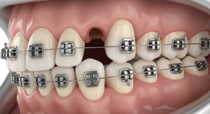 کشیدن دندان برای ارتودنسی