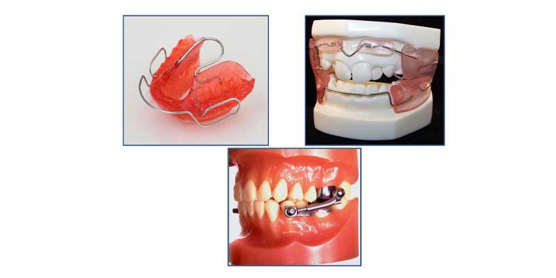 ارتودنسی فانکشنال