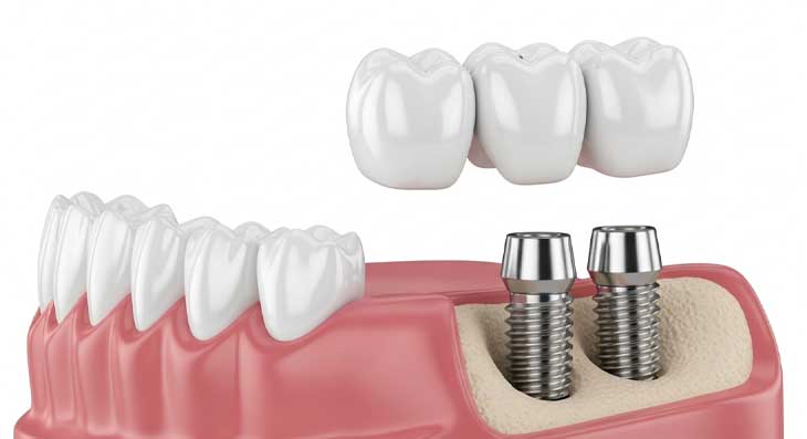 ایمپلنت دو دندان کنار هم