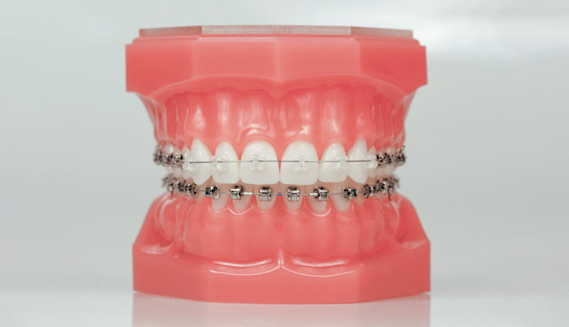 ارتودنسی سرامیکی در تهران