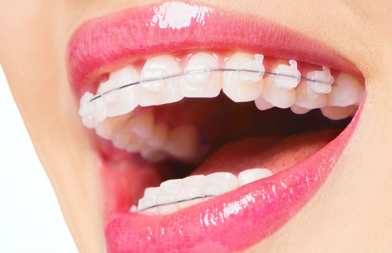 متخصص ارتودنسی سرامیکی در تهران