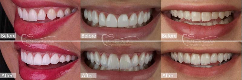 لمینت سرامیکی