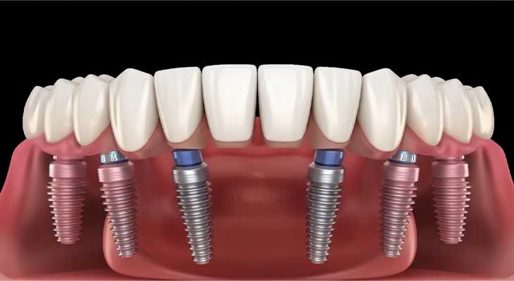 ایمپلنت All-on-6
