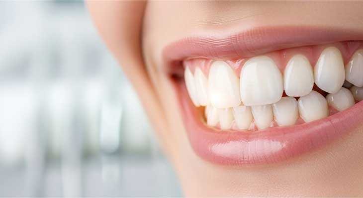 کامپوزیت ونیر دندان