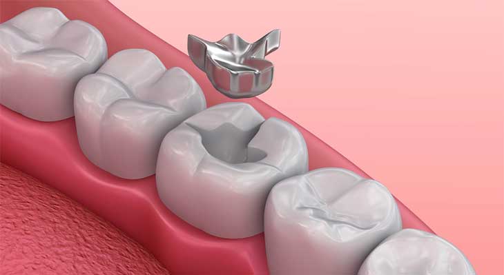 آمالگام چیست؟