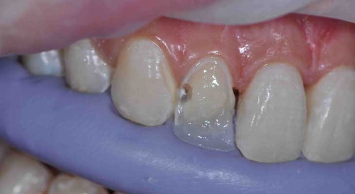 کامپوزیت دندان به روش لیرینگ چیست؟