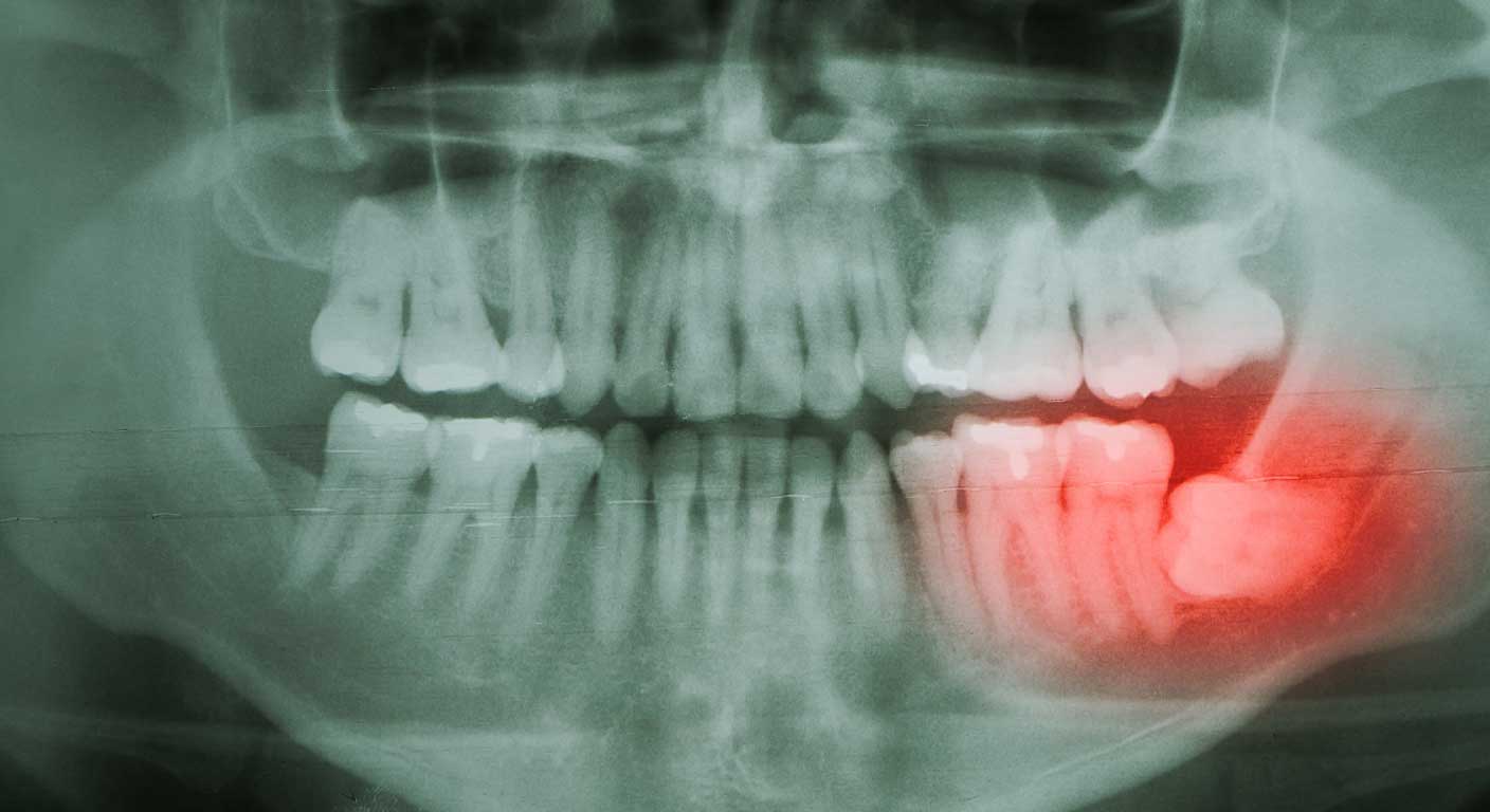 دندان عقل نهفته