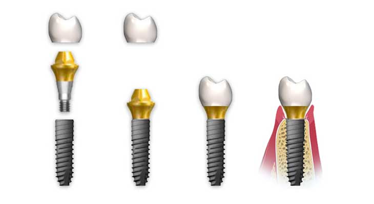 ایمپلنت دنتیوم