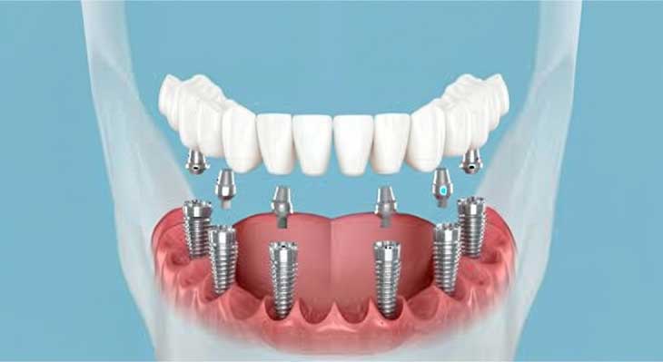 ایمپلنت All-on-6