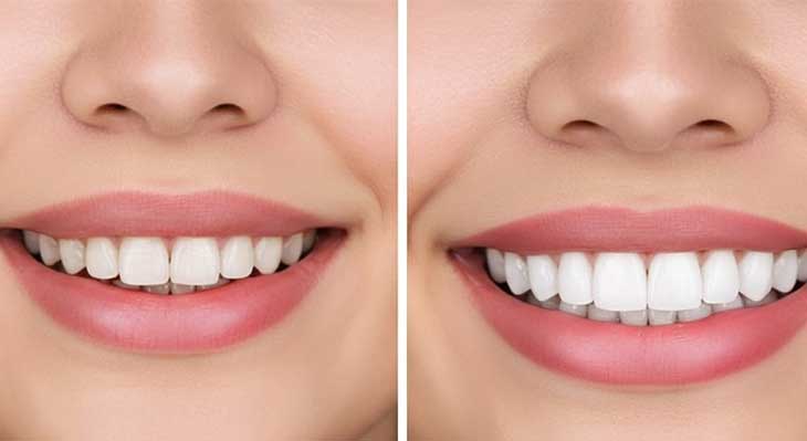 کامپوزیت ونیر دندان